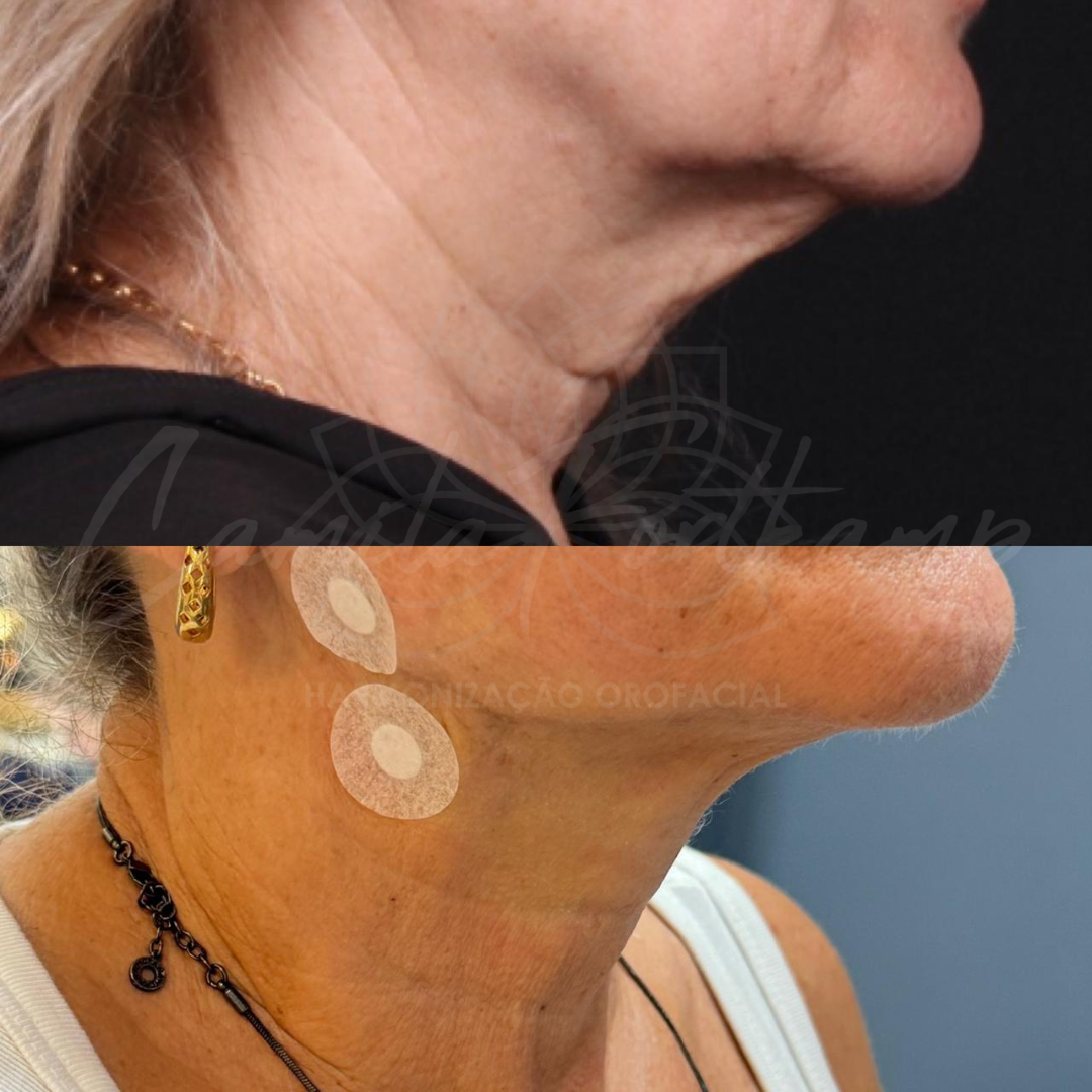 Contorno facial